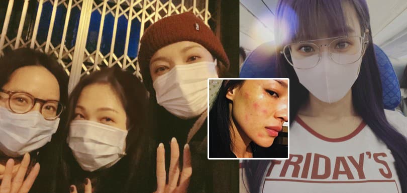 日日戴口罩狂爆暗瘡出紅疹！5大重點對付戴口罩後遺症