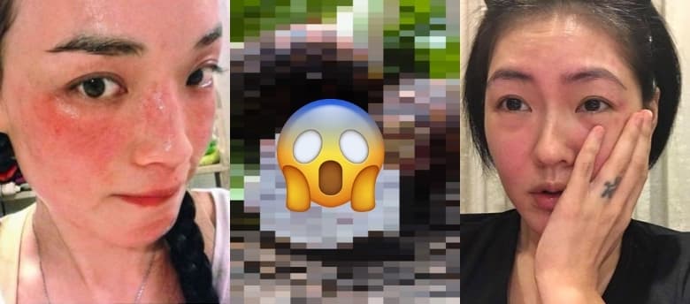 濕疹要戒口？除了蝦蟹，原來芋頭和xx都不宜吃！記住8大誘發濕疹食物